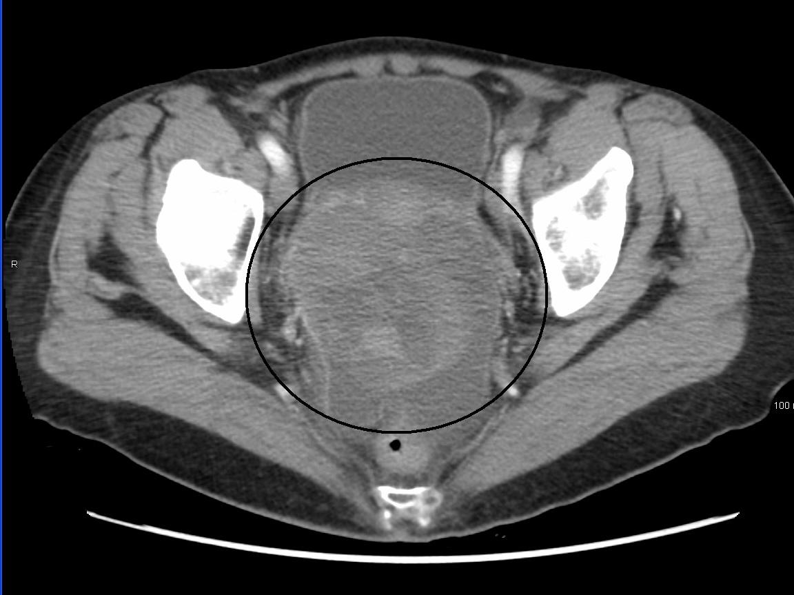 Ovarian cancer imaging techniques. Ovarian cancer imaging techniques.